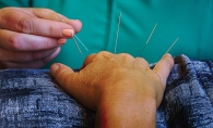 A patient receives acupuncture treatment at Balanced Being in Excelsior.